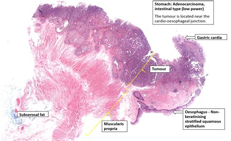 Adenocarcinoma Invasivo E Ulcerado