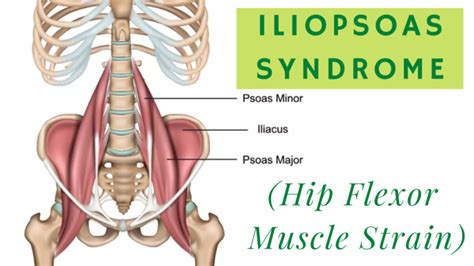 Iliopsoas Syndrome Orthopaedic Spine Surgery Singapore