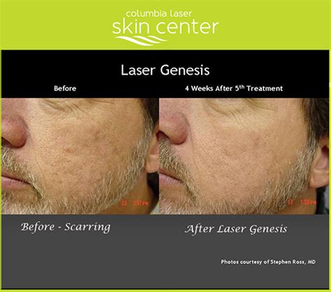 Laser Genesis Before And After Columbia Laser Skin Center