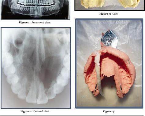 Figure 4 From Role Of Obturator In Conservative Management Of