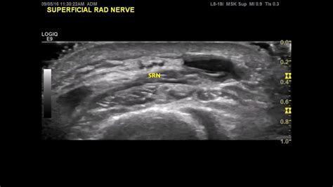 Course Of Radial Nerve In The Forearm Youtube