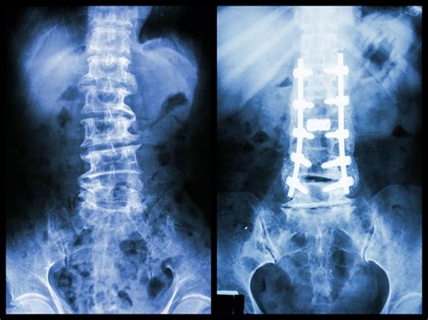 What Happens When Spine Hardware Breaks Dr Sinicropi