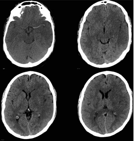 Figure 3 From Brain Ischemia Ct And Mri Techniques In Acute Ischemic