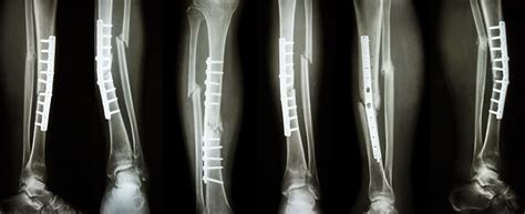 Collection Image Of Leg Fracture And Surgical Treatment Stock Photo