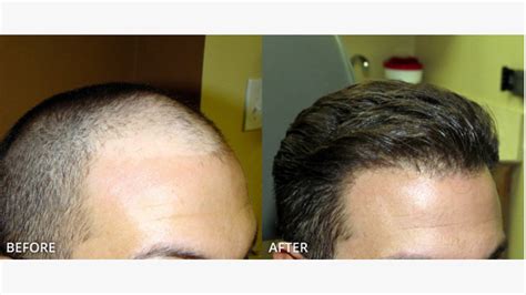 How Much Does A Hair Transplant Cost HazelNews