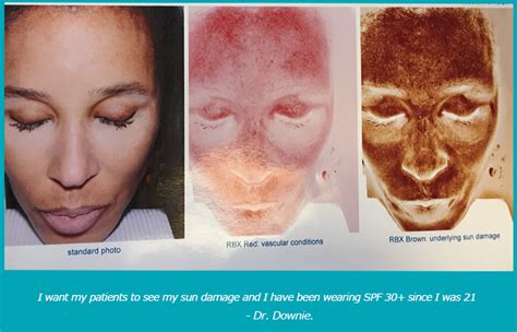 Chemical Peels Montclair Nj Melasma Treatment Sun Damaged Skin
