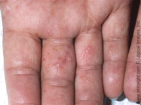 What Is Dyshidrotic Eczema And How Do You Know If You Have It Eczema