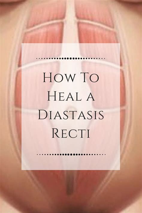 Diastasis Recti Abdominal Separation During And After Vrogue Co
