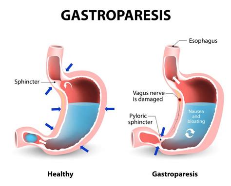 Gastroparesis Causes Symptoms And Treatment Medical News Today