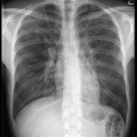 A ground glass is an element of many camera viewfinder systems, for example reflex and view cameras. Pneumocystis pneumonia | Image | Radiopaedia.org
