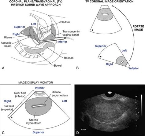 Transvaginal Scanning Protocol For The Female Pelvis Radiology Key