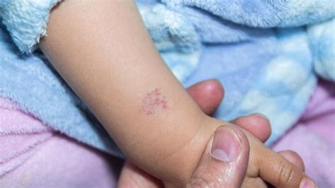 Blue Birthmarks Bruises In Children Can They Go Away This Is The