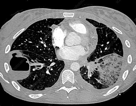 Pneumonia And Lung Abscess Ct Stock Image C0394180 Science