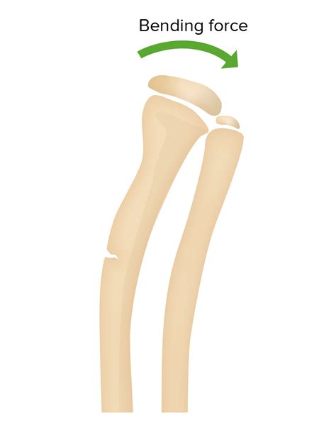 Greenstick Fracture Definition And Treatment Lecturio Medical