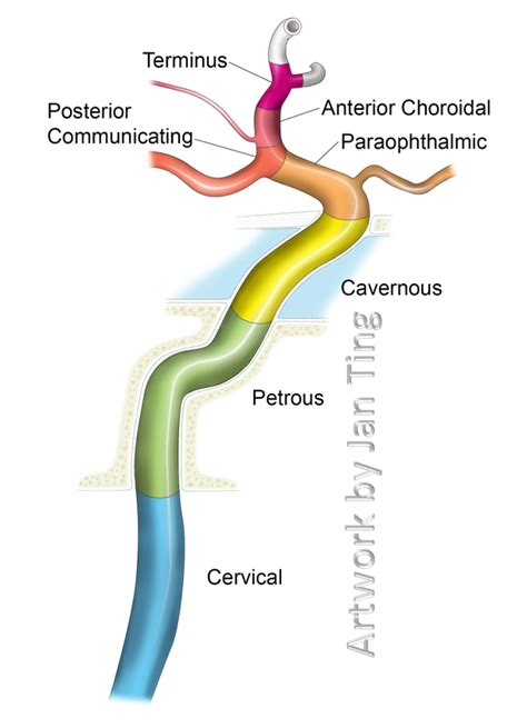 A case report her external carotid arteries and their branches were normal. Internal Carotid Artery NYU Classification | Anatomía ...