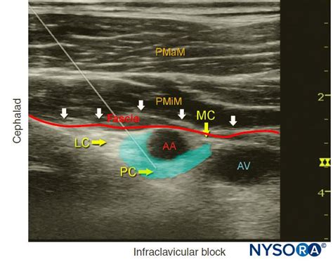 Ultrasound Guided Infraclavicular Brachial Plexus Block Nysora