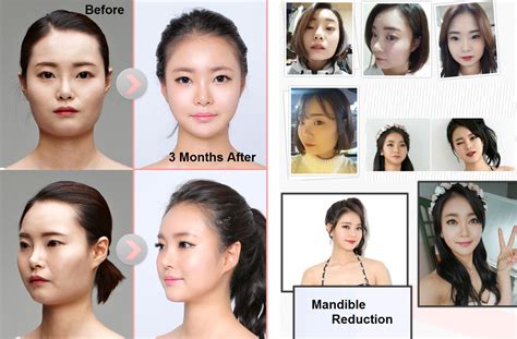 Plastic Surgery Before And After Archives Seoul Guide Medical