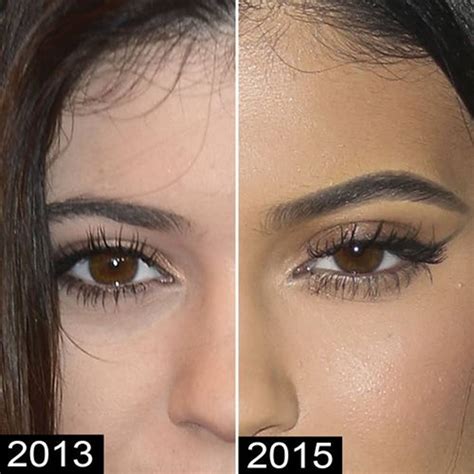 Kylie Jenner Before and After Plastic Surgery Photos ...