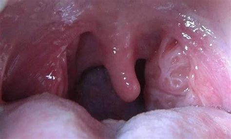 5 Quick Ways You Can Get Rid Of Swollen Tonsils Easily At Home By