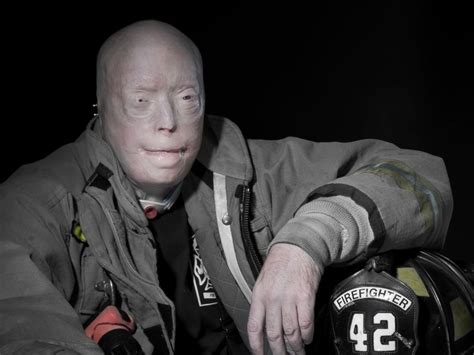 This Firefighters Mask Melted To His Face—15 Years Later His Transformation Stuns The World