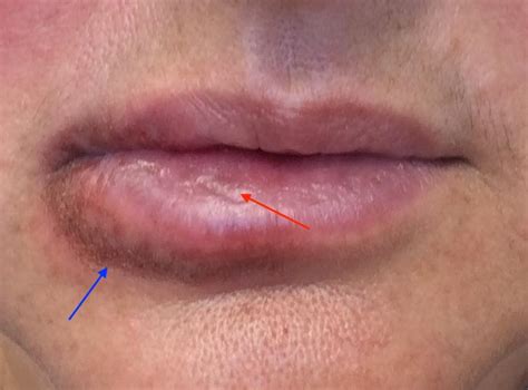Purple Spot On Lips Lipstutorial Org