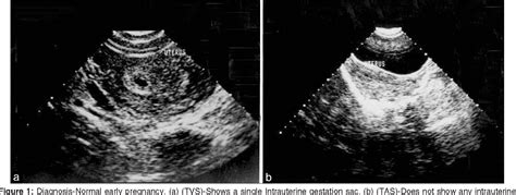 Figure 1 From Transvaginal Ultrasonography In First Trimester Of