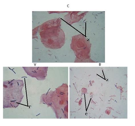 Gram Staining Of Vaginal Fluid Smears L Lactobacillus Morphotype