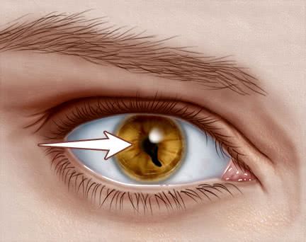 Infections, like shingles or herpes. Coloboma — Symptoms, Causes, and Management