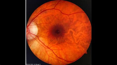 Macular Hemorrhage Associated With Lacquer Crack In High Myopia Youtube