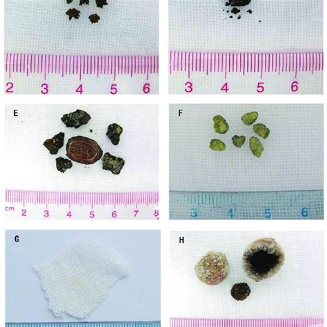 The Appearance Of Each Type Of Gallbladder Stone A Cholesterol Stone