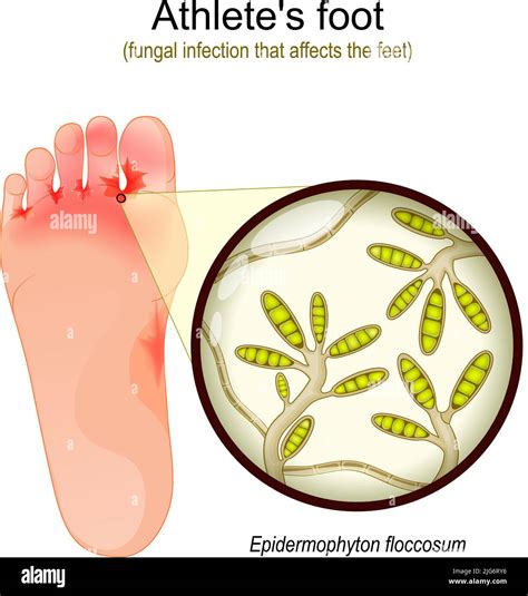 Athletes Foot Infection Stock Vector Images Alamy