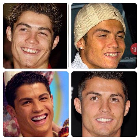 Cristiano Ronaldo Before And After Morably Braces And Care Brackets