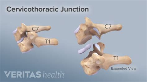 Pin On Cervicothoracic Junction Kyphosis