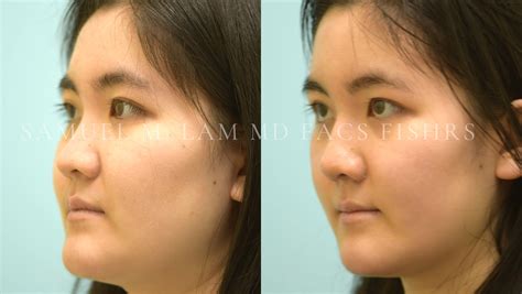 Dallas Rhinoplasty Nose Job Before And After Photos Plano Plastic