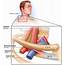 Thoracic Outlet Syndrome Causes Symptoms Diagnosis Exercise & Treatment