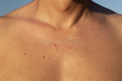 Red Acne A Rash In The Chest Area Of A Guy Closeup Unhealthy Skin
