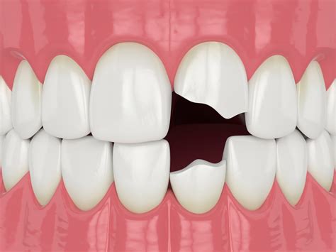 7 Ways To Fix A Broken Tooth Pain Relief And Costs