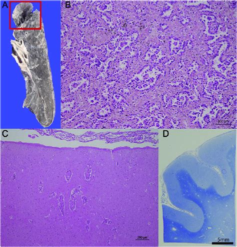 Pathological Findings A 5 × 20 × 15 Mm Nodular Lesion With Irregular