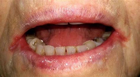 Natural Remedies For Angular Cheilitis Dental News Micro Blogs