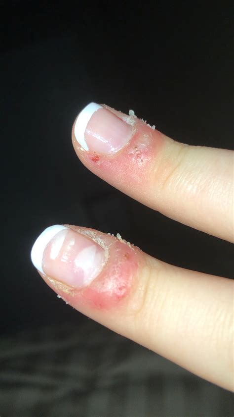 I Used To Always Pick My Cuticles And Now I Have These Two Warts And