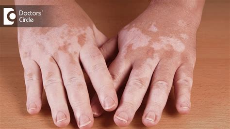 What Are The Causes Of Vitiligo Dr Aruna Prasad Youtube