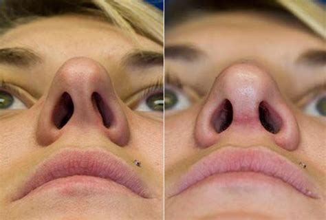 Deviated Septum Nose Job Before And After Micki Vincent