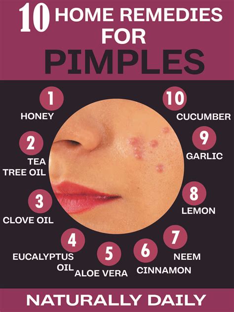 16 Natural Home Remedies For Pimples Evidence Based Home Remedies For Pimples Pimples