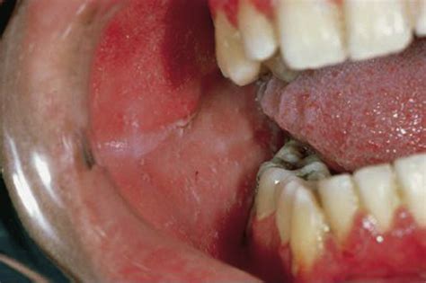 Oral Viral Infections Dental Clinics