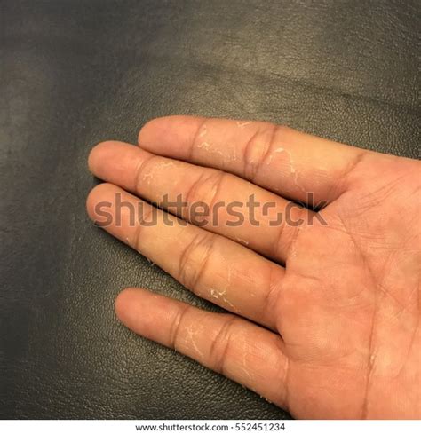 Hand Skin Peeling Due Allergic Reaction Stock Photo 552451234