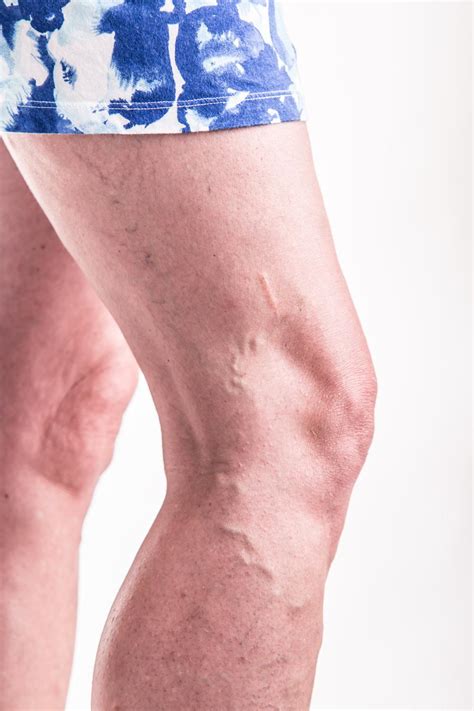 Varicose Veins Causes Symptoms And Treatment