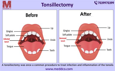 Various Conditions That Affects The Tonsil Part