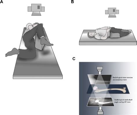 A Patient Is Placed In A Lateral Decubitus Position On The Affected