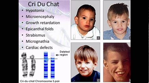 Pathophysiology 16 Chromosomal Abnormalities Youtube