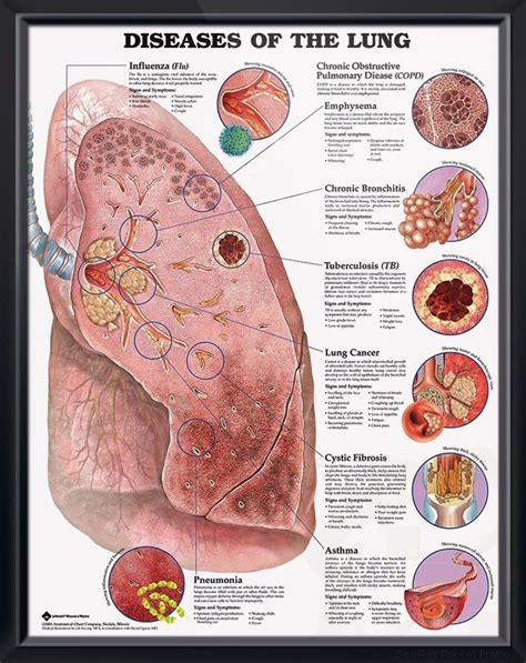 Poster Shows Prominent Diseased Lung With Close Up Illustrations Of